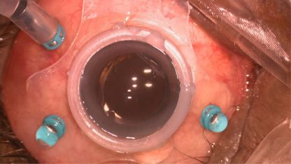 Steady Ring (Self Stabilizing Ring) - Image 2