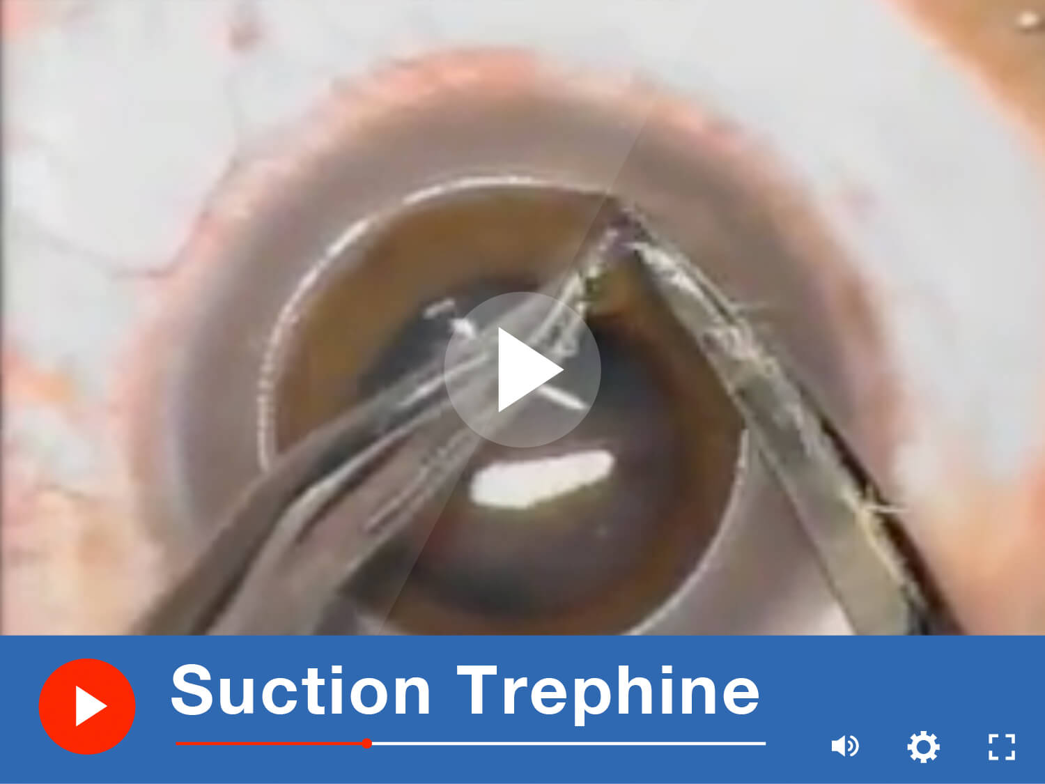 Suction Trephine