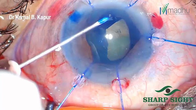 Iris Retractor 1 Dr Kamal Kapur